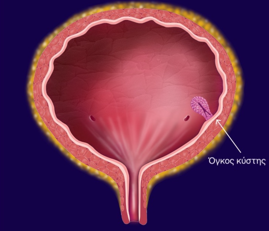 Επιφανειακός όγκος κύστεως - αιματουρία - Δρ. Μερτζιώτης Ουρολόγος Αθήνα
