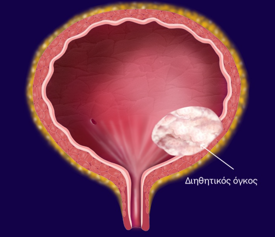 Διηθητικός όγκος κύστεως - καρκίνος κύστεως - Δρ. Μερτζιώτης Ουρολόγος Αθήνα
