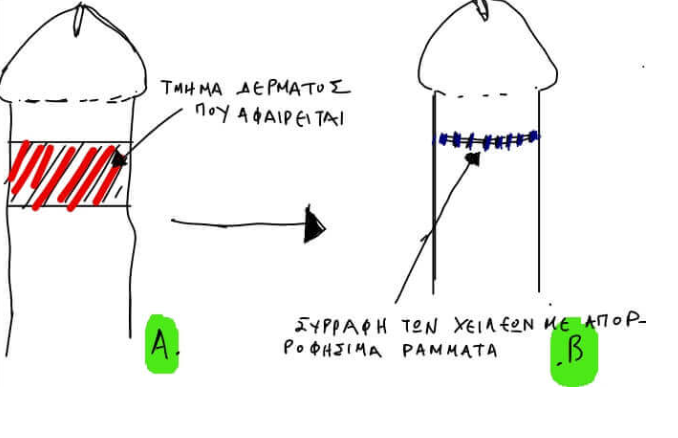 Χειρουργική αντιμετώπιση φίμωσης - τεχνική περιτομής - αφαίρεση δέρματος και συρραφή - Δρ. Μερτζιώτης Ουρολόγος Αθήνα