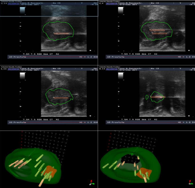 Εστιακή θεραπεία προστάτη - τρισδιάστατη χαρτογράφηση βιοψιών με υπέρηχο MRI fusion - Δρ. Μερτζιώτης Ουρολόγος Αθήνα