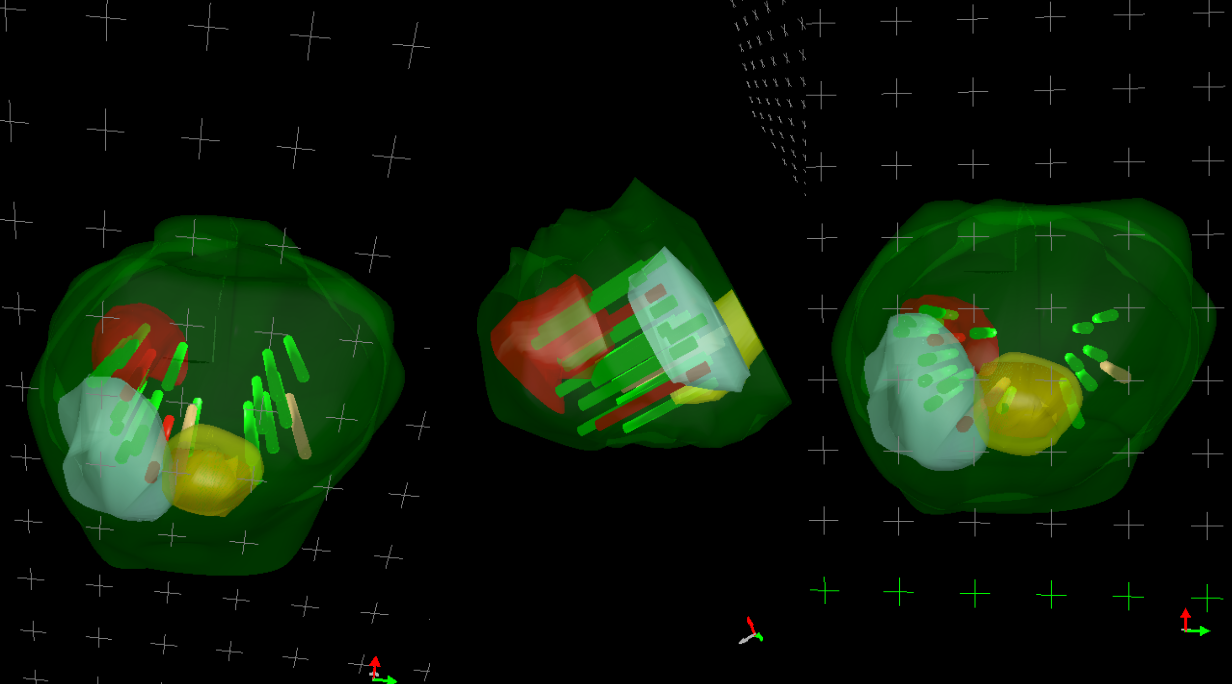 3D χαρτογράφηση βιοψιών προστάτη - Fusion Βιοψία MRI υπέρηχος - Δρ. Μερτζιώτης Ουρολόγος Αθήνα